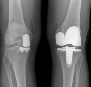 half knee replacement