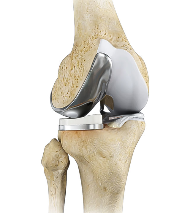 manu knee replacement