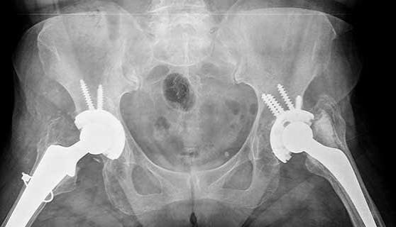 best hip replacement surgeon in ahmedabad