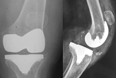 best joint replacement surgeon in ahmedabad