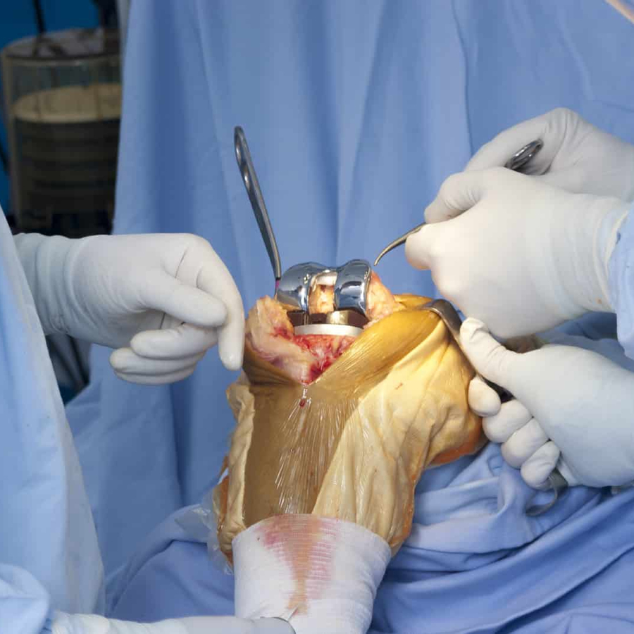 Knee replacement surgery